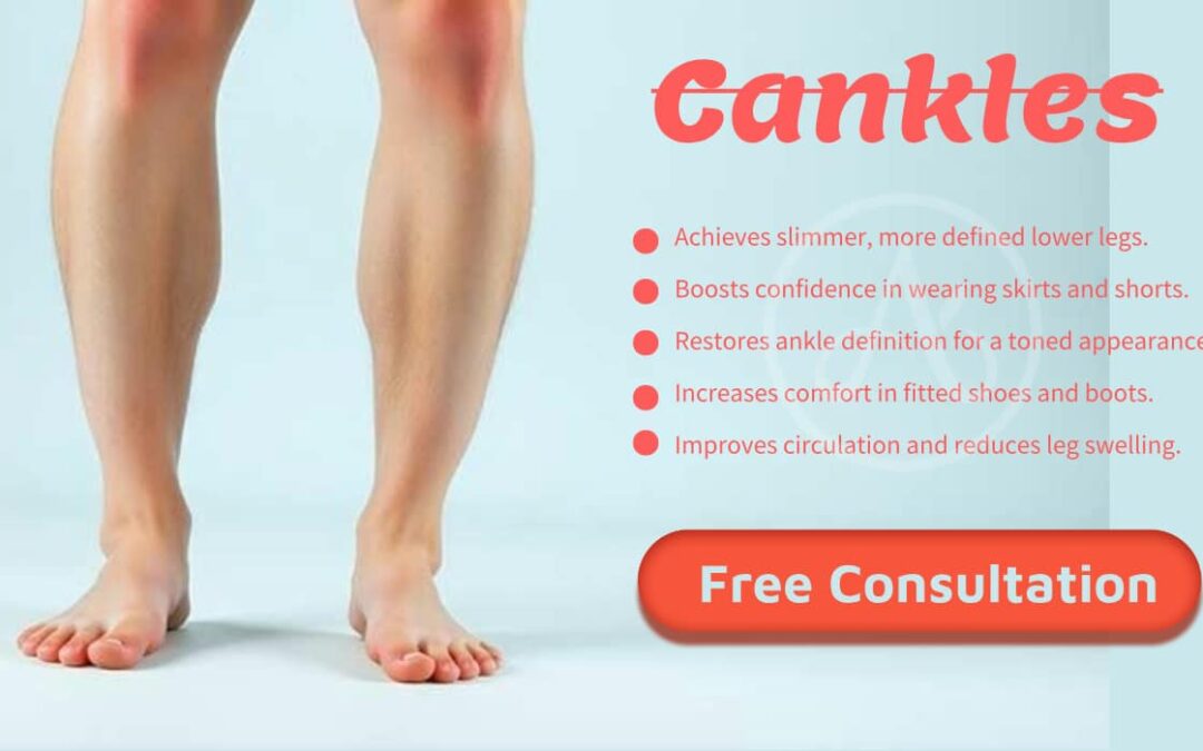 What Are Cankles? Understanding the Causes, Differences, and Treatment Options